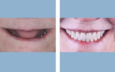 Before and After